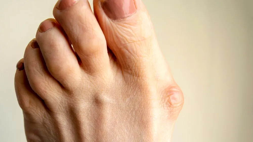 Вальгусная деформация первого пальца стопы. Косточка на ноге – лечение в СПБ