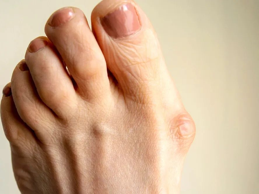 6 причин, из-за которых появляется шишка на ноге